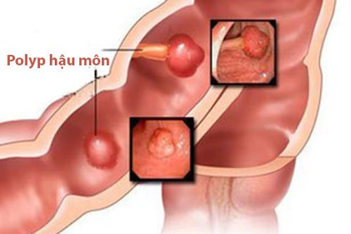 Đa polyp hậu môn